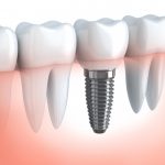 Low cost dental implants for seniors